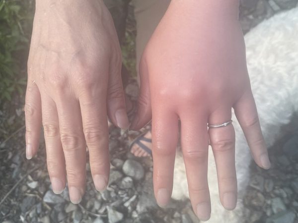 ポイズンリムーバーがあれば遅くとも２分以内に使用すると効果的